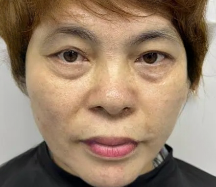 去眼袋手术