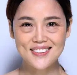 去眼袋手术