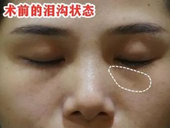 泪沟填充