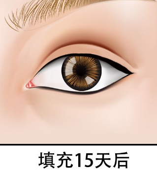 泪沟填充