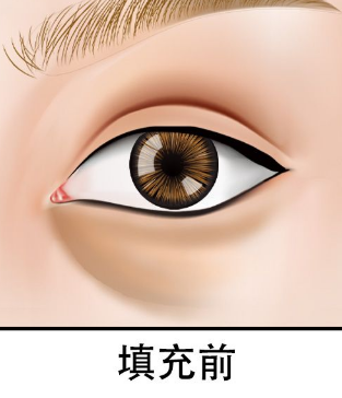 泪沟填充