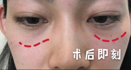 泪沟填充