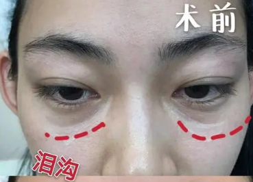 泪沟填充