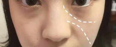 泪沟填充