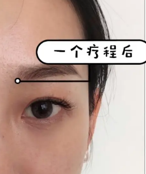 泪沟填充