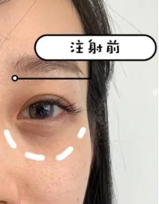 泪沟填充