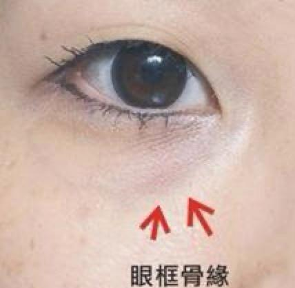 泪沟填充