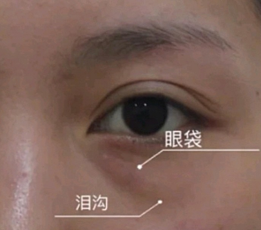 泪沟填充