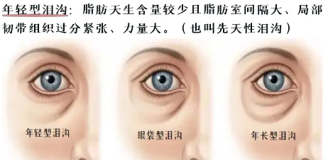 泪沟填充