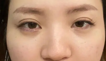 泪沟填充