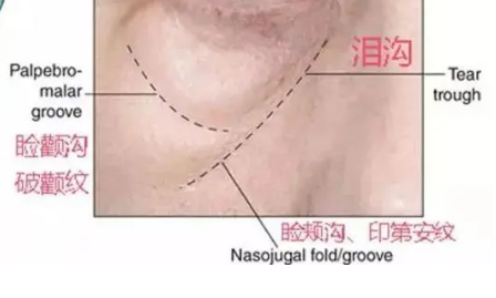 泪沟填充