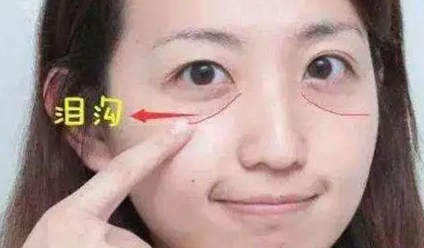 泪沟填充