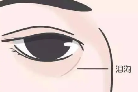 泪沟填充