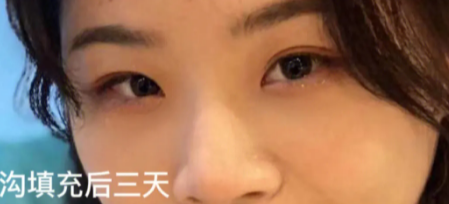 泪沟填充