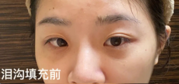 泪沟填充