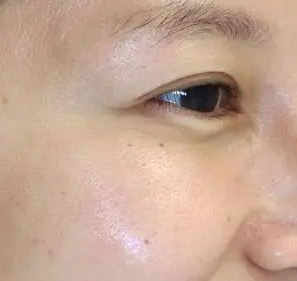 泪沟填充