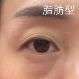 去眼袋手术
