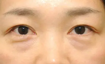 眼袋