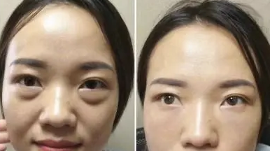 眼袋