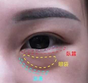 泪沟填充