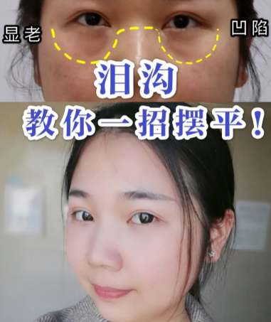 泪沟填充