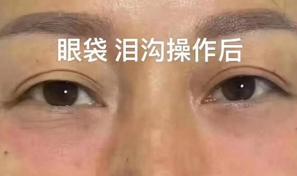 泪沟填充