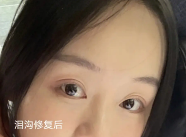 泪沟填充