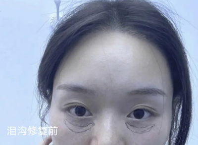 泪沟填充