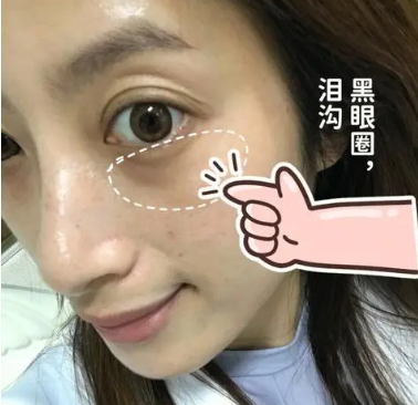 泪沟填充