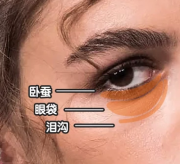 泪沟填充