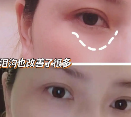 泪沟填充
