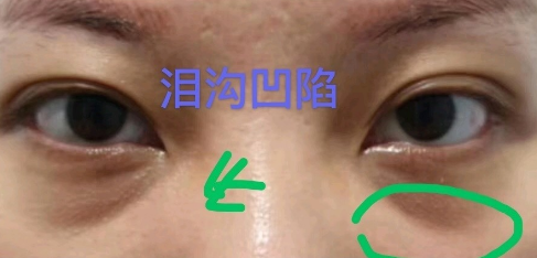 泪沟填充