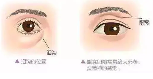 泪沟填充
