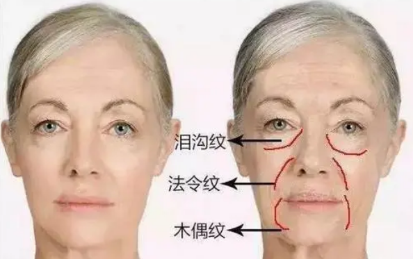 自体脂肪胶