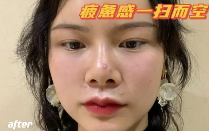 自体脂肪胶