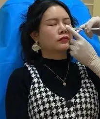 自体脂肪胶