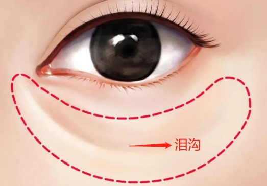 自体脂肪胶