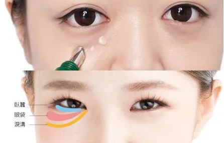 自体脂肪胶
