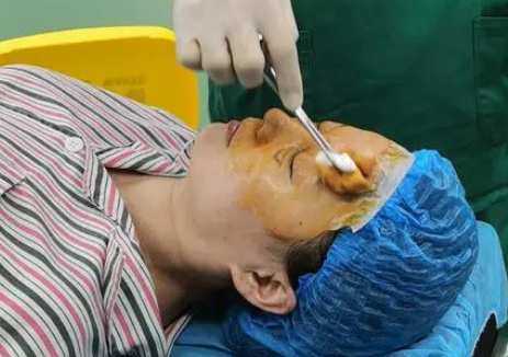 自体脂肪胶