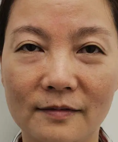 自体脂肪胶