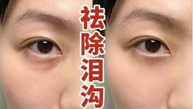 自体脂肪胶