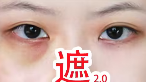 泪沟填充