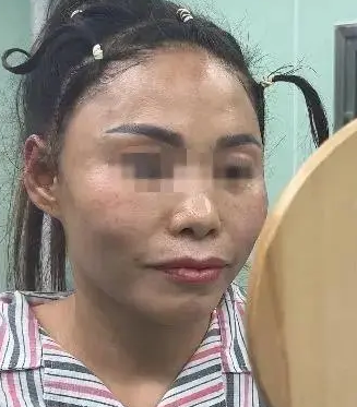 自体脂肪胶