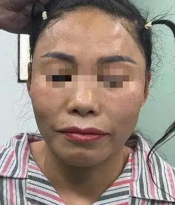自体脂肪胶
