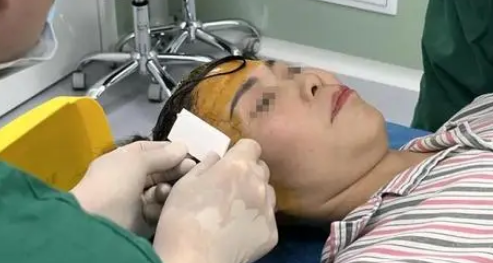 自体脂肪胶