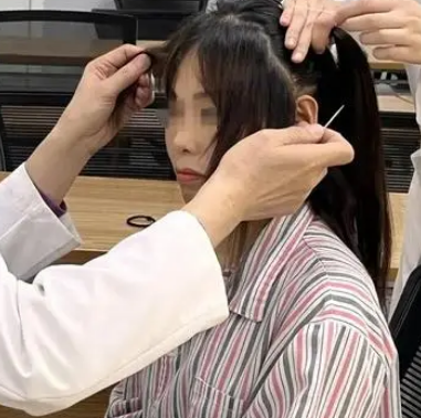 自体脂肪胶