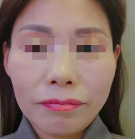 自体脂肪胶
