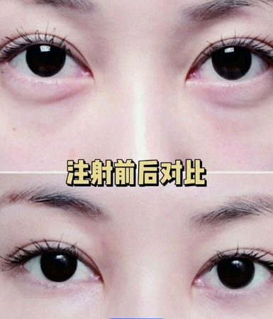 泪沟填充