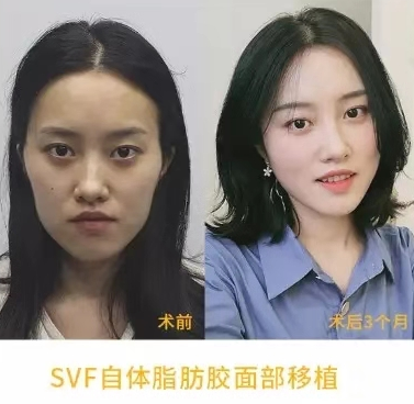自体脂肪胶