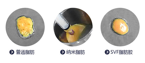 自体脂肪胶